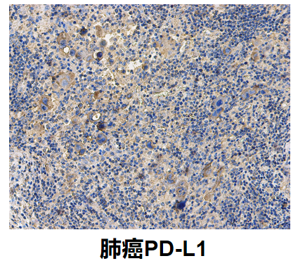 肺癌PDL1.png